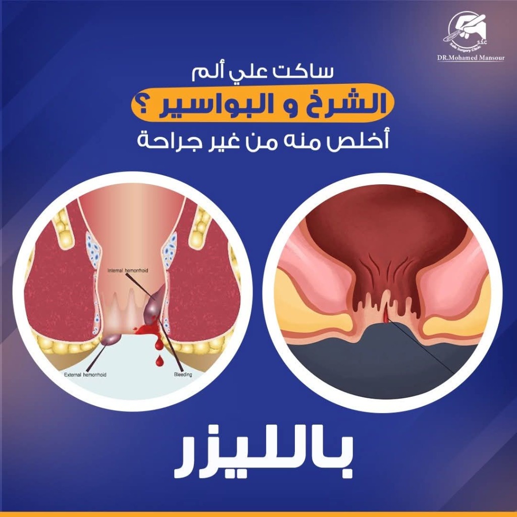 علاج البواسير والشرخ بالليزر